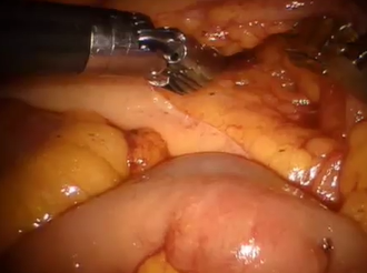 One-stage laparoscopic hepatic resection & robot-assisted right colectomy+abdominoperineal resection One-stage laparoscopic hepatic resection & robot-assisted right colectomy+abdominoperineal resection
