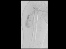 Onyx Embolization of Arteriovenous Malformation of Right Upper Arm Onyx Embolization of Arteriovenous Malformation of Right Upper Arm