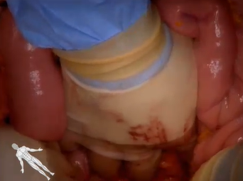 Open Abdominal Aortic Aneurysm AAA Repair (Maham Rahimi, MD & Travis Vowels, MD) Open Abdominal Aortic Aneurysm AAA Repair (Maham Rahimi, MD & Travis Vowels, MD)