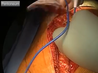 Open Aorta Abdomen and Iliacs Case - Part 1 of 4 (ALAN B. LUMSDEN, MD) Open Aorta Abdomen and Iliacs Case - Part 1 of 4 (ALAN B. LUMSDEN, MD)