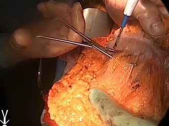 Open Aorta: Completed Aortoiliac IMA Control and Omental Flap (Alan B. Lumsden, MD) Open Aorta: Completed Aortoiliac IMA Control and Omental Flap (Alan B. Lumsden, MD)
