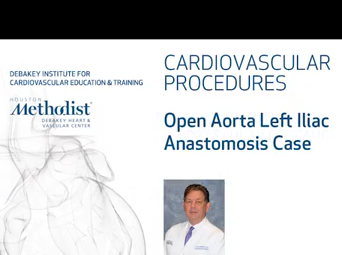 Open Aorta Left Iliac Anastomosis Case - Part 4 of 4 (ALAN B. LUMSDEN, MD) Open Aorta Left Iliac Anastomosis Case - Part 4 of 4 (ALAN B. LUMSDEN, MD)