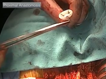 Open Aorta Proximal Anastomosis Case - Part 2 of 4 (ALAN B. LUMSDEN, MD) Open Aorta Proximal Anastomosis Case - Part 2 of 4 (ALAN B. LUMSDEN, MD)