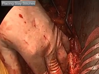 Open Aorta Right Iliac Anastomosis Case - Part 3 of 4 (ALAN B. LUMSDEN, MD) Open Aorta Right Iliac Anastomosis Case - Part 3 of 4 (ALAN B. LUMSDEN, MD)