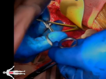 Open Aortic Aneurysm Repair (Maham Rahimi, MD & Manuel Rojo, MD) Open Aortic Aneurysm Repair (Maham Rahimi, MD & Manuel Rojo, MD)