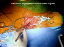 Open Aorto Bifemoral Bypass - Retroperitoneal Approach Open Aorto Bifemoral Bypass - Retroperitoneal Approach