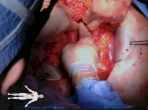 Open IVC Filter Removal Open IVC Filter Removal