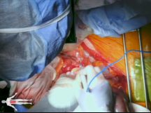 Open Repair of AAA & Internal Iliac Artery Aneurysm After Failed EVAR Open Repair of AAA & Internal Iliac Artery Aneurysm After Failed EVAR