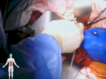 Open Repair of Abdominal Aortic Aneurysm (Charudatta Bavare, MD, M. Mujeeb Zubair, MD) Open Repair of Abdominal Aortic Aneurysm (Charudatta Bavare, MD, M. Mujeeb Zubair, MD)