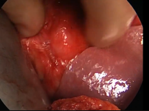 Open Repair of Renal Artery Aneurysm in Solitary Kidney Open Repair of Renal Artery Aneurysm in Solitary Kidney