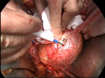 Open Repair of Type 2 Endoleak with Graft Retention Open Repair of Type 2 Endoleak with Graft Retention