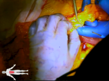 Open Surgical Repair of SMA Aneurysm Open Surgical Repair of SMA Aneurysm