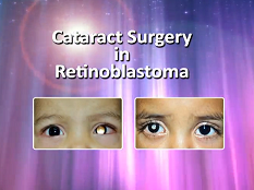 Ophtalmologie pédiatrique, Strabisme - Chirurgie de la Cataracte sur des rétinoblastomes : Techniques et Astuces Ophtalmologie pédiatrique, Strabisme - Chirurgie de la Cataracte sur des rétinoblastomes : Techniques et Astuces