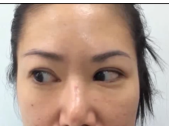 Opsoclonus in a Patient After Treatment