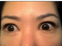 Opsoclonus in a Patient Before Treatment