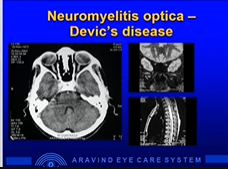 Optic Disc Edema - A case based Approach Speaker: Prof. (Dr.) Mahesh Kumar
