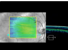 Optical Coherence Tomography in Sibling 4 Optical Coherence Tomography in Sibling 4