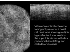 Optical Coherence Tomography Raster of Basal Cell Carcinoma