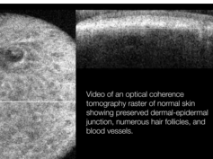 Optical Coherence Tomography Raster of Normal Skin