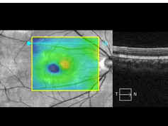 Optical Coherence Tomography Video Through a Conforming Focal Choroidal Excavation Optical Coherence Tomography Video Through a Conforming Focal Choroidal Excavation