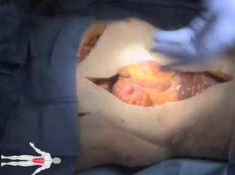 Optimal Retractor Placement for Aortic Surgery (John F. Eidt, MD and M. Mujeeb Zubair, MD) Optimal Retractor Placement for Aortic Surgery (John F. Eidt, MD and M. Mujeeb Zubair, MD)