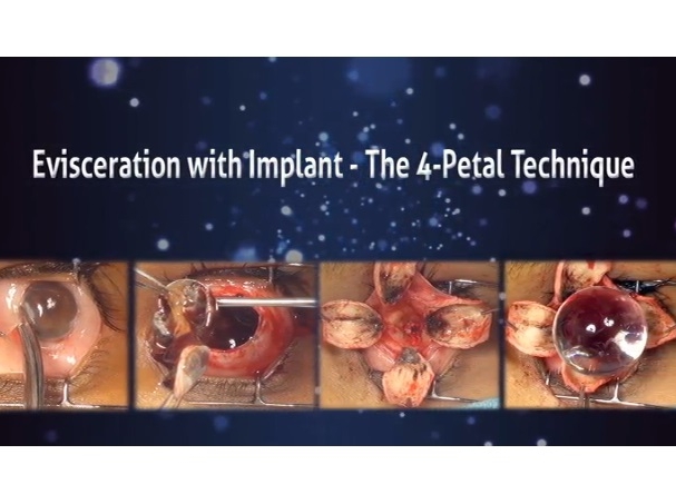 Orbit, Lacrimal, Plastic Surgery - Evisceration With Implant: The 4-Petal Technique (3D-Enabled Video)