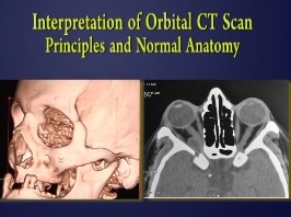 Orbite, Lacrymal, Chirurgie Plastique - Interprétation d'un scanner tomographique orbital : anatomie et principes Orbite, Lacrymal, Chirurgie Plastique - Interprétation d'un scanner tomographique orbital : anatomie et principes