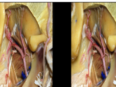 Orbitozygomatic Approaches (3D TV)