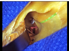 Orbitozygomatic Approaches