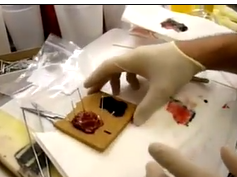 Orientation of Transoral Robotic Surgery Specimen in Pathology