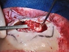 Osteoplastic Flap for Frontal Sinus Fibrous Dysplasia