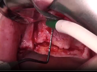 Osteoplastic piezoelectric insertion