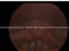 Outcomes After Adjuvant Vocal Fold Steroid Injection for Fibrosis After Microlaryngeal Surgery Outcomes After Adjuvant Vocal Fold Steroid Injection for Fibrosis After Microlaryngeal Surgery