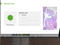 Ovarian Diseases: Benign Cysts  Pathology Ovarian Diseases: Benign Cysts  Pathology