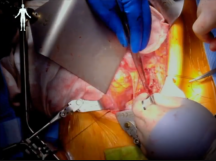 Ovarian Vein Transposition Ovarian Vein Transposition