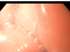 Ovesco Clips after Repair of Gastric Sleeve Leak