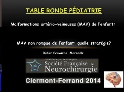 Pédiatrie (4/7) - Malformation artério-veineuse (MAV) non rompue de l'enfant : quelle stratégie ? Pédiatrie (4/7) - Malformation artério-veineuse (MAV) non rompue de l'enfant : quelle stratégie ?