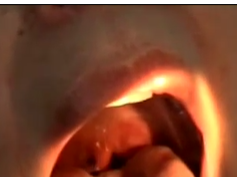 Palatal Tremor Palatal Tremor