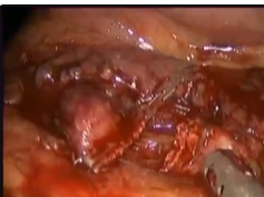 Pancreatic Transection With Radiofrequency Energy During Laparoscopic Distal Pancreatectomy