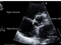 Paradoxical Embolus-in-Transit