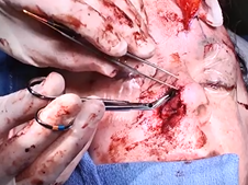 Paramedian Forehead Flap for Nasal Reconstruction