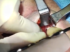 Parathyroidectomy for Parathyroid Adenoma