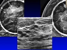 Parenchymal asymmetries: definition, evaluation and management