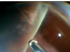 Pars Plana Vitrectomy Alone With Diffuse Illumination and Vitreous Dissection to Manage Primary Reti Pars Plana Vitrectomy Alone With Diffuse Illumination and Vitreous Dissection to Manage Primary Reti