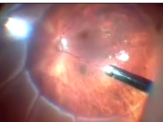Pars Plana Vitrectomy Alone With Diffuse Illumination and Vitreous Dissection to Manage Primary Reti Pars Plana Vitrectomy Alone With Diffuse Illumination and Vitreous Dissection to Manage Primary Reti