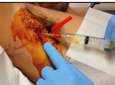Part 1 - Abscess Core Removal