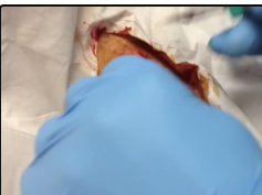 Part 2 of Core removal of Abscess