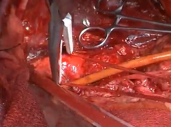 Partial Stent Graft & Renal Snorkel Explantation for 1A Endoleak (A Lumsden, MD, T MacGillivray, MD) Partial Stent Graft & Renal Snorkel Explantation for 1A Endoleak (A Lumsden, MD, T MacGillivray, MD)