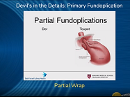 Partial Wrap