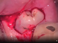 Partially impacted mandibular left third molar